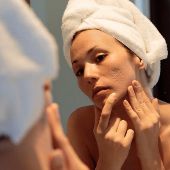 Adult acne